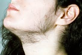 Hair loss is a possible symptom of hypothyroidism or hyperthyroidism. Hirsutism You And Your Hormones From The Society For Endocrinology