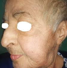 Image result for Hypertrichosis