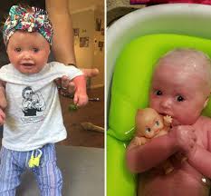 Baby girl born with rare condition called harlequin ichthyosis that means  she sheds her skin 10 TIMES faster