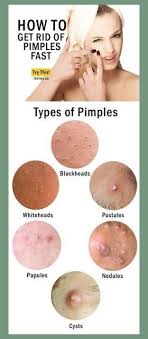 Maybe you would like to learn more about one of these? How To Get Rid Of Papules Overnight Rejoinder