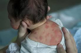 Image result for sweat rash on back baby