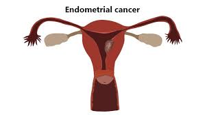 The inside lining of the uterus is called the endometrium; Endometrial Cancer Treatment Cost In India Endometrial Treatment