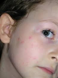 They are usually just a reaction to something and go in a short time. Natural Home Remedy For Hives New Life On A Homestead Homesteading Blog