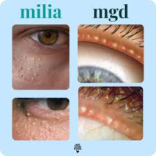 Image result for milium cyst on eyelid