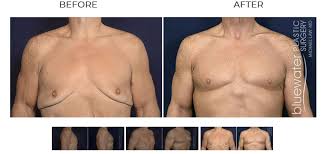 Image result for Gynecomastia