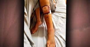 Necrotizing fasciitis may occur in any anatomic location; Flesh Eating Bacteria Florida Woman S Death During Gulf Vacation From Necrotizing Fasciitis Shines Light On Rare Infection Cbs News