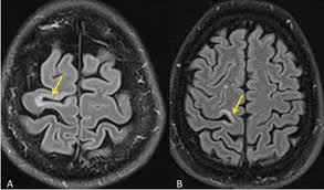Multiple lesions in different regions of the brain) but also in time. Nuevos Conceptos Sobre El Papel De La Resonancia Magnetica En El Diagnostico Y Seguimiento De La Esclerosis Multiple Sciencedirect