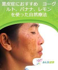 黒皮症におすすめ ヨーグルト バナナ レモンを使った自然療法 みんな健康 自然療法 顔 シミ 消す シミ 消す