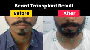 Hair transplant in ambala, haryana is the simple dermatology surgical procedure involving the shifting of hair follicles from the permanent donor area around the sides and back head, to the areas having less or no hair. Beard Transplant Case Study With Before After Results Fue Full Beard Transplant Youtube
