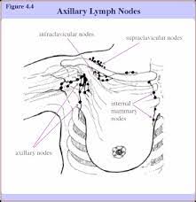 These cancers, if left alone, would likely spread throughout the body. Breast Cancer Lymph Node Status