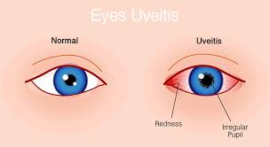 Image result for Uveitis
