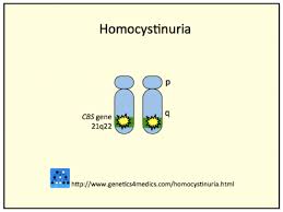 Image result for Homocystinuria