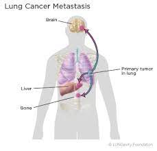 It usually starts growing near the center of the lung, near one of bronchus (the main airways of the. How Lung Cancer Develops Lungevity Foundation