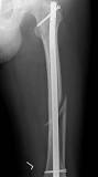 ‫مسمار نخاعي - ويكيبيديا‬‎