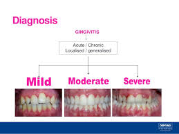 This means that the physician or dentist can arrive at the diagnosis by listening to the person's medical and dental history. Gingivitis