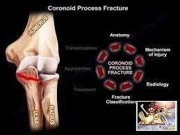 Image result for Coronoid Process Fracture