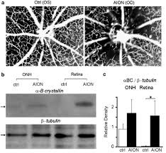 Jul 06, 2021 · anterior ischaemic optic neuropathy (aion) anterior ischaemic optic neuropathy (aion) shares many similarities with the cerebrovascular phenomenon referred to as a stroke. Functional Rescue Of Experimental Ischemic Optic Neuropathy With A B Crystallin Eye
