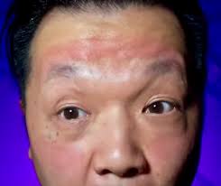 Red Face Marks from AR/VR Devices-EXPLAINED