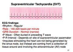 Supraventricular Tachycardia Google Search Ekg Interpretation Nursing School Tips Ecg Interpretation