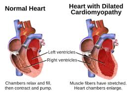 Image result for Cardiomyopathy