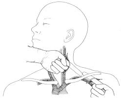 We did not find results for: Axillo Internal Carotid Artery Bypass In The Treatment Of Neck Metastases Journal Of Vascular Surgery
