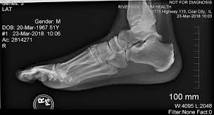 I am sorry that you continue to have foot pain. What Is A Foot Xray Two Views