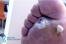 Owrzodzenie stopy na skutek cukrzycy występuje na całej grubości skóry właściwej i jest powikłaniem bardzo ciężkim w leczeniu. Leczenie Stopy Cukrzycowej Tarnow Instytut Podologiczny