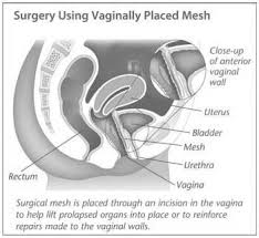 Pin On Surgery Complications