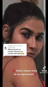 Comparación de cuerpos operados y naturales: Odalys Velasco antes y después  de la cirugía