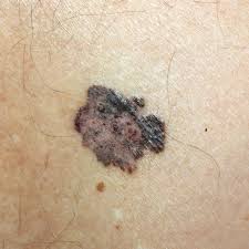 When the cancerous cells have grown through the basement membrane and into the dermis it is known as invasive melanoma and is termed a superficial spreading melanoma. Current Management Of Malignant Melanoma State Of The Art Intechopen
