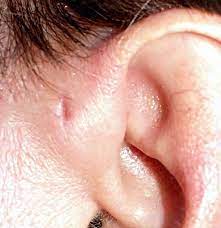 A will need b would need c need d needed. Hole In Ear Preauricular Pit What To Know