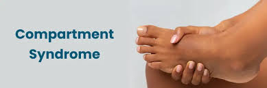 Image result for Compartment Syndrome