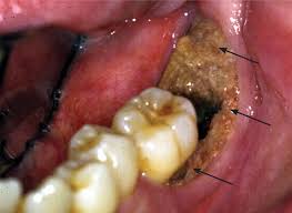 Image result for Bisphosphonates