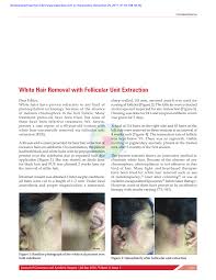 But that does not mean black hair has gooseberries can also be used as a hair treatment solution to help you restore the natural appearance of your hair to get back to having a nice black look. Pdf White Hair Removal With Follicular Unit Extraction