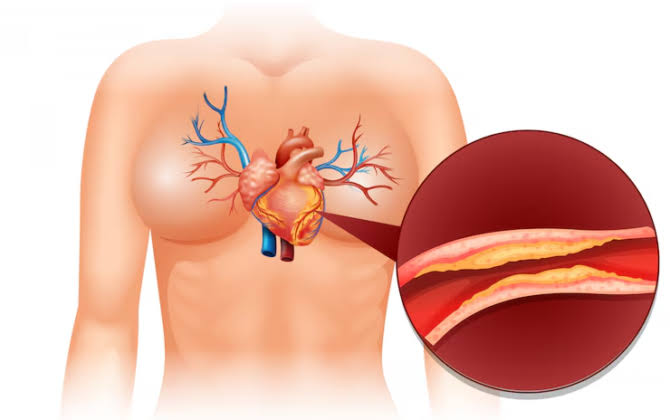 ارتفاع الكولسترول : أنواعه، أسبابه، أعراضه وطرق العلاج الطبيعية والدوائية -  منصة شفاء