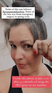 Have you experienced hair loss recently? Per this article in The Atlantic  you are not alone. One of the leading causes of hair loss is STRESS! Who  has not been under an