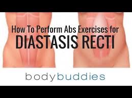 Exercises For Diastasis Recti How To Fix Ab Separation Youtube Diastasis Recti Diastasis Workout For Flat Stomach