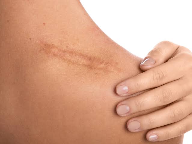 Scar Revision Surgery: What It Is, How It Works and What to Expect in  Melbourne