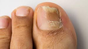 31 best ciuperca unghiei images. Cum Poti Trata Naturist Ciuperca Unghiei Buna Ziua Iasi Bzi Ro