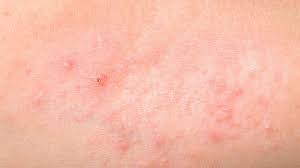 Image result for itchy skin rectum