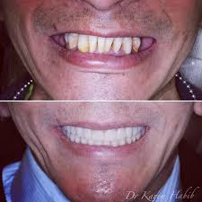 Jul 15, 2021 · approximately, the cost per tooth ranges from $800 to $1500. All Teeth On 4 Dental Implants Sydney Full Mouth Fixed Dental Implants Dentist Ryde Gladesville North Ryde Parramatta Epping Hunters Hill