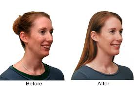 Overbite and underbite correction without surgery. Corrective Jaw Surgery Orthognathic Reynolds Oral Facial Surgery