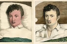 Image result for Yellow Fever