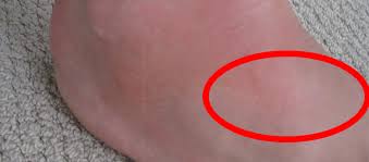 Pin On Morton S Neuroma Foot Pain