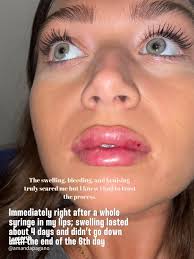 My Lip Filler Journey: Overcoming Fears and Gaining Confidence