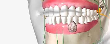Image result for dental cancer