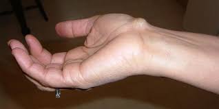 Pergelangan tangan yang sakit bisa disebabkan oleh banyak hal, seperti cedera maupun penyakit seperti artritis, hingga carpal tunnel syndrome. Mengenal Penyakit Ganglion Kista Jinak Pada Pergelangan Tangan Diadona Id