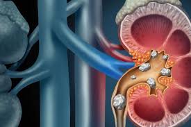 Delving Into The Why Of Urinary Stent Pain Newsroom