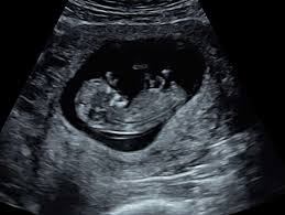 Thus, a simple and accurate way to date the fetus in an early pregnancy is to add the length of the fetal pole (in mm) to 6 weeks. Our Early Scans Explained Window To The Womb