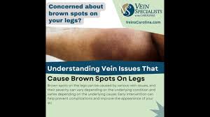 Image result for liver spots on legs